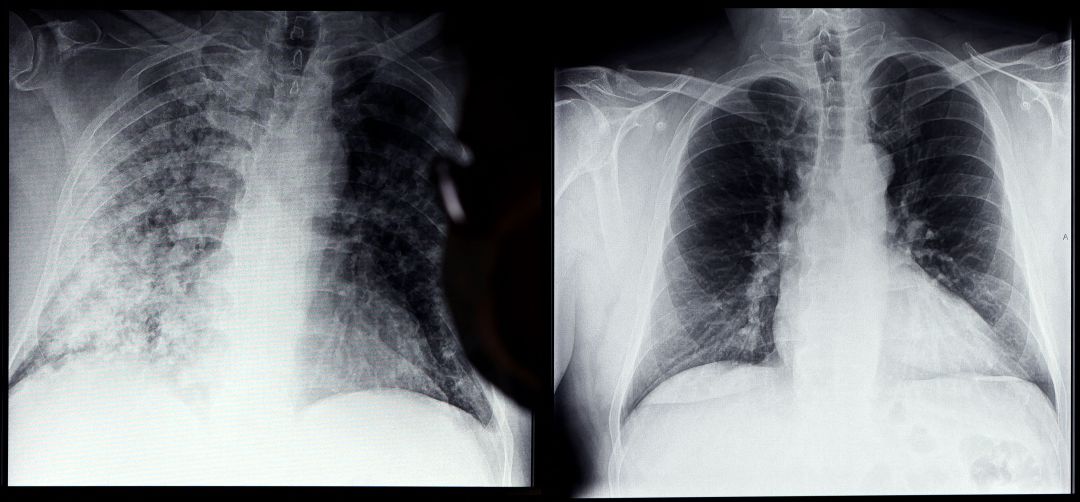 Este sistema informático es capaz de analizar miles radiografías que muestran el estado de los pulmones de personas. Este sistema informático es capaz de analizar miles radiografías que muestran el estado de los pulmones de personas.