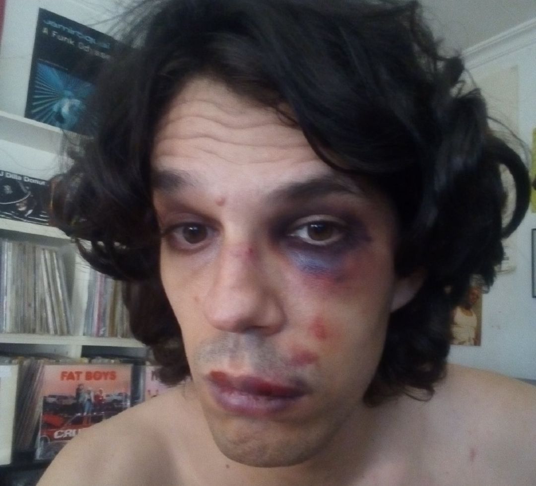 Este joven de Murcia ha compartido a través de sus redes sociales los daños sufridos en su enfrentamiento con los agentes Este joven de Murcia ha compartido a través de sus redes sociales los daños sufridos en su enfrentamiento con los agentes