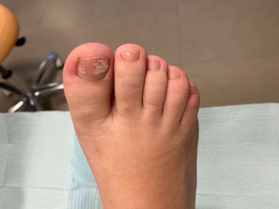 Hongos en las uñas de los pies Hongos en las uñas de los pies