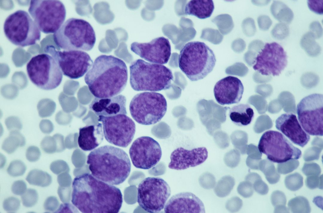 Vista de células cancerígenas. Vista de células cancerígenas.
