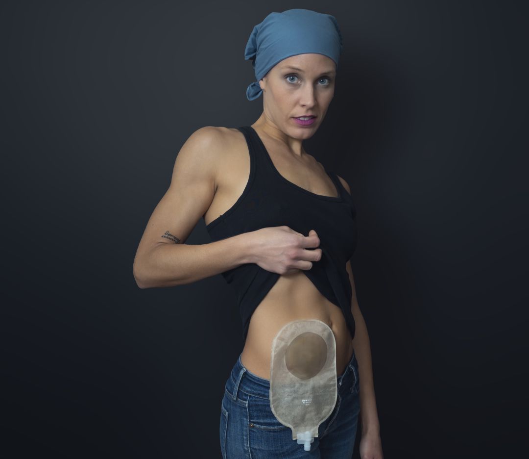La campaña lleva por título: Disfruta tu verano, también con ostomía La campaña lleva por título: Disfruta tu verano, también con ostomía