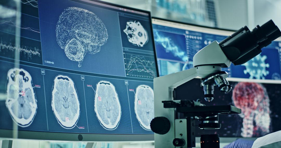 Los responsables del estudio apuntan que lo que vieron en los cerebros de fallecidos por coronavirus se parece mucho a lo que se observa en los de las personas que murieron de afecciones neurodegenerativas como el Alzheimer y el Parkinson Los responsables del estudio apuntan que lo que vieron en los cerebros de fallecidos por coronavirus se parece mucho a lo que se observa en los de las personas que murieron de afecciones neurodegenerativas como el Alzheimer y el Parkinson