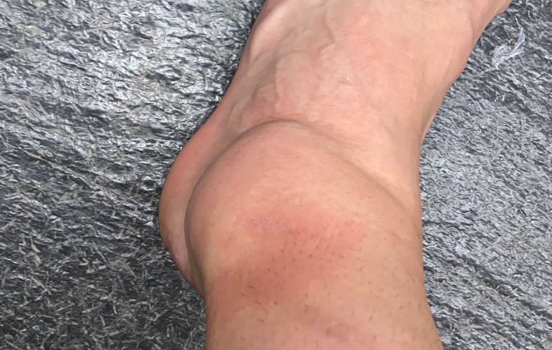 El tobillo de Dani Ceballos. El tobillo de Dani Ceballos.