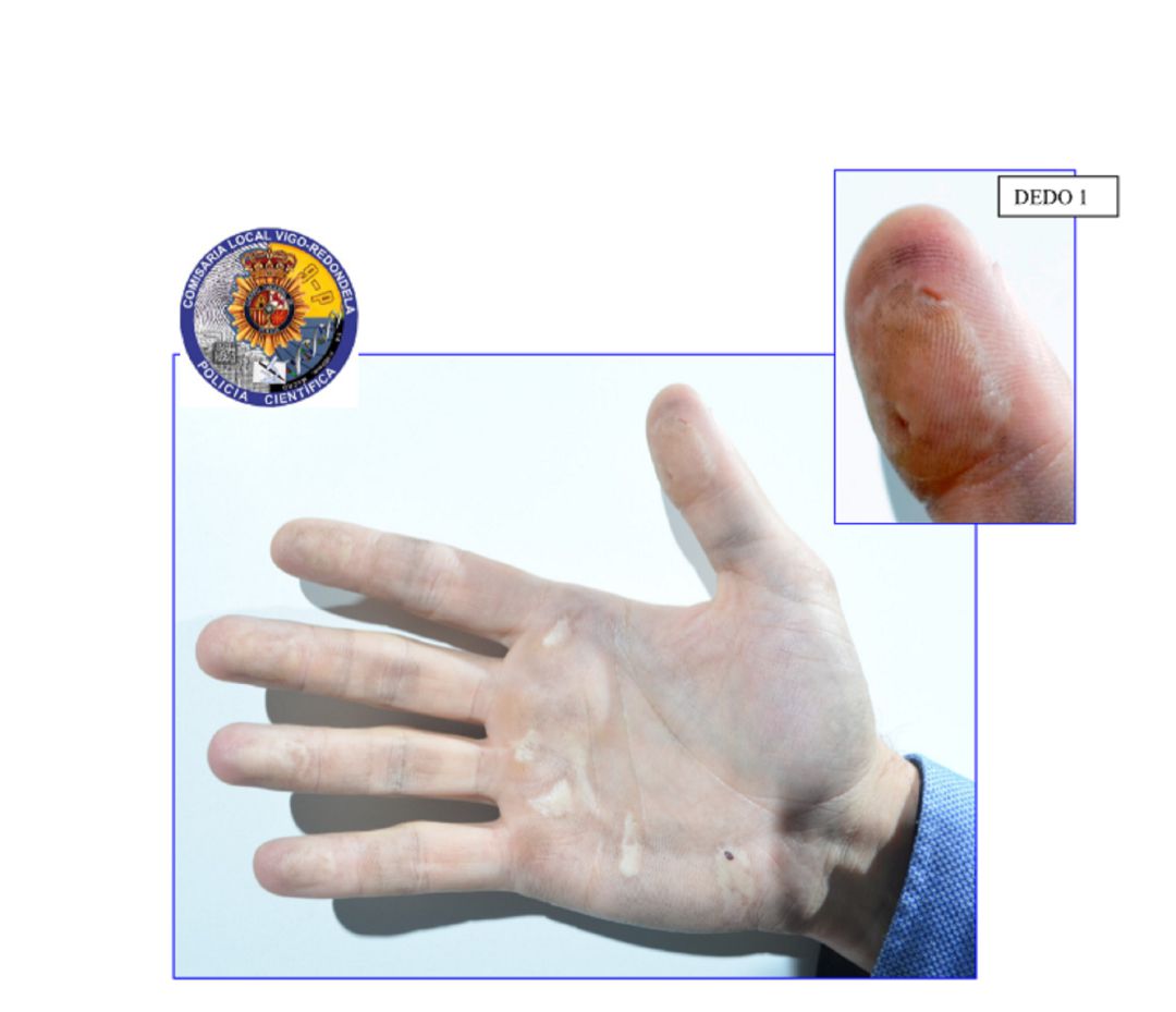 Imagen de la mano y y del dedo de uno de los detenidos Imagen de la mano y y del dedo de uno de los detenidos