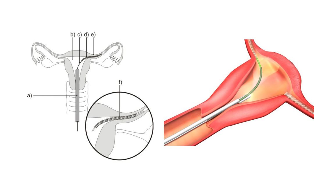 Mètode anticonceptiu Essure, retirat del mercat Mètode anticonceptiu Essure, retirat del mercat