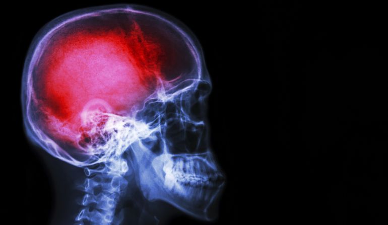 Nuevo tratamiento para el ictus cerebral