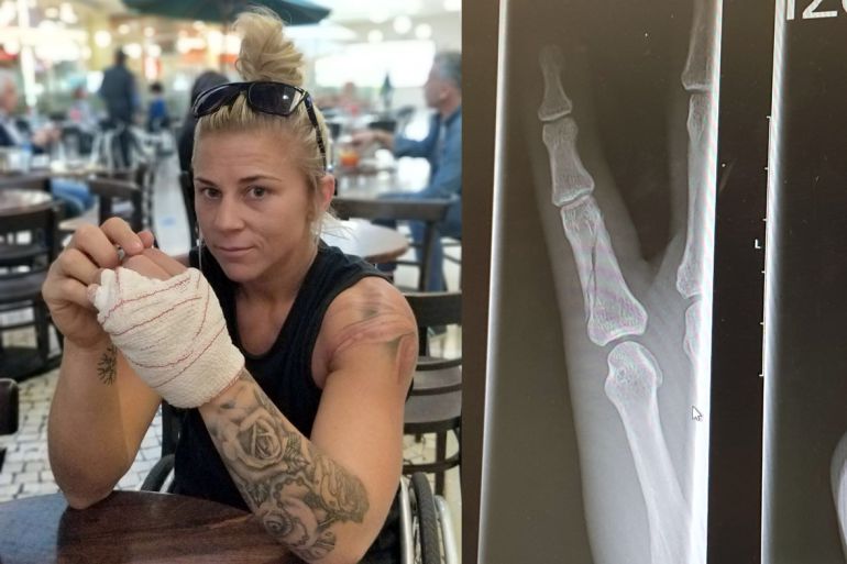 La radiografía de Shelly revela una fractura en el dedo