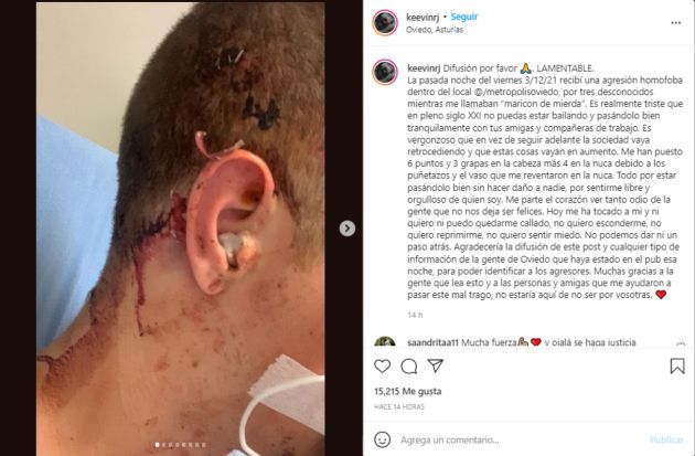 Este joven denuncia que tres individuos le atacaron al gripo de "Maricón de mierda" en la noche del viernes en Oviedo
