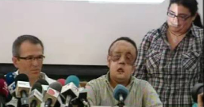El paciente trasplantado de cara en Sevilla recibe el alta médica