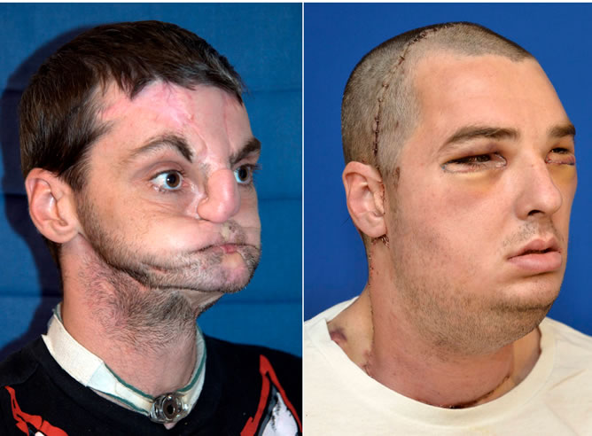 Norris tenía 22 años cuando un accidente con un arma de fuego le dejó con el rostro hundido y sin labios, nariz y la parte delantera de la lengua.
