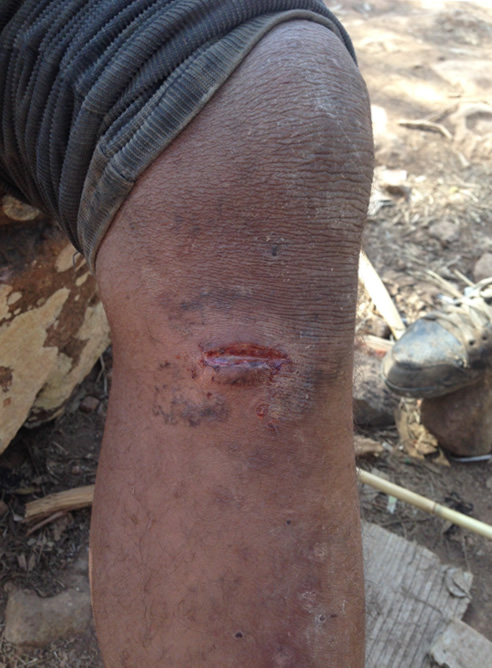 Este maliense muestra una herida producida por el alambre de cuchillas de la valla que nunca ha estado de estar colocado en el lado marroquí de la barrera