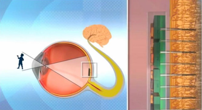 Proceso de implantación de la retina artificial en un ojo humano