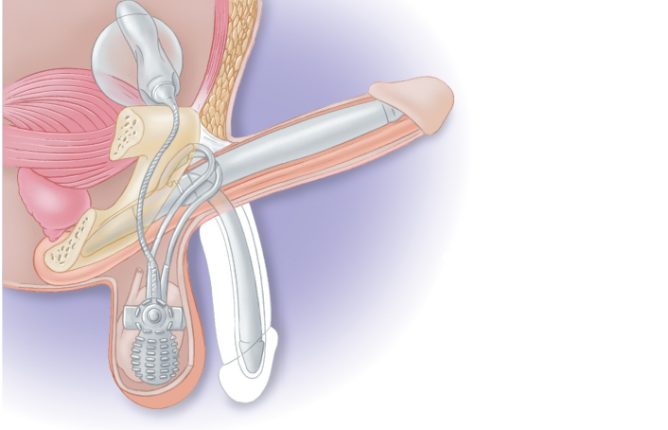 La ilustración muestra cómo funciona el implante funcional de pene