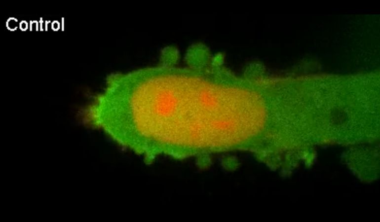 tumor metastásico iniciado desde la próstata