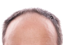 disfunción eréctil después del trasplante de cabello instagram disfunción eréctil después del trasplante de cabello instagram