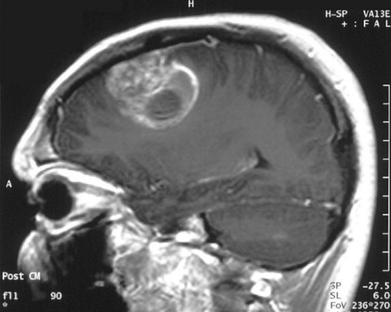 cuanto puede vivir una persona con metastasis cerebral