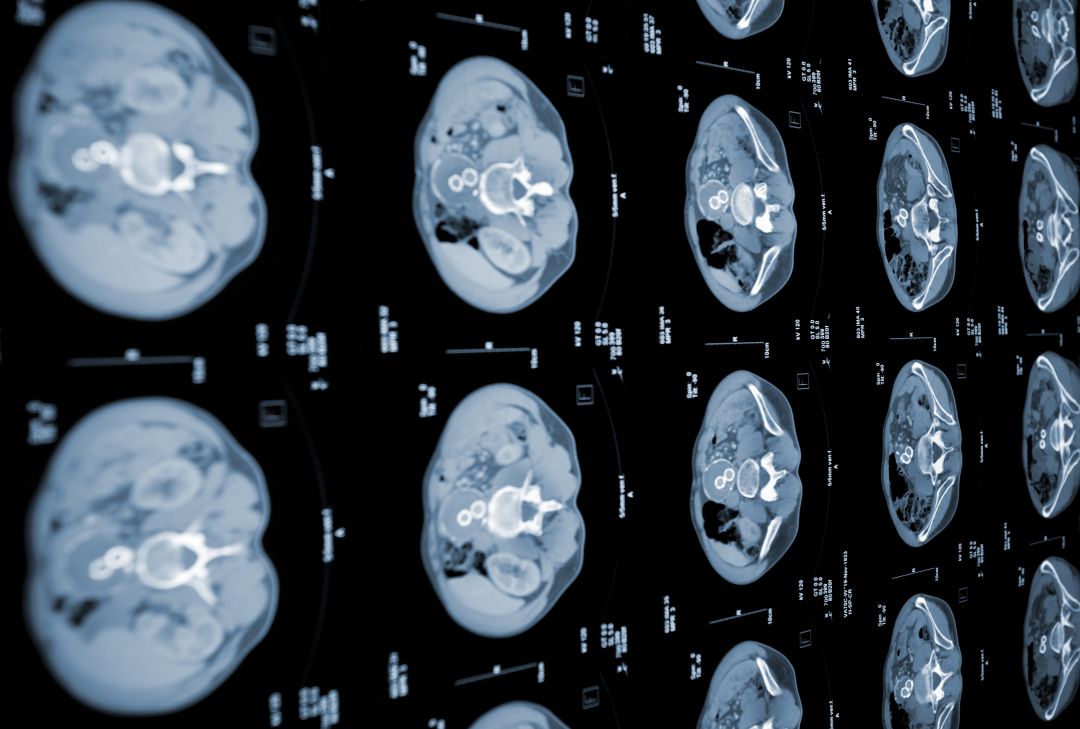 Analisis con de sangre un detectar cancer