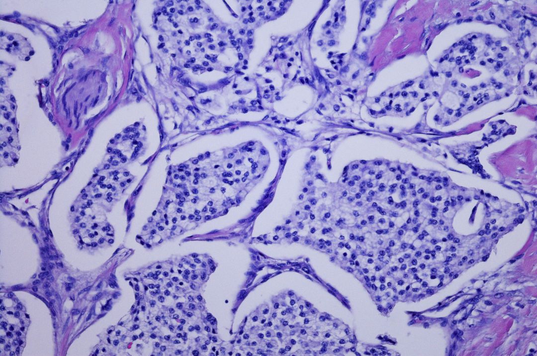 estudio sobre el cáncer de próstata olaparib estudio sobre el cáncer de próstata olaparib