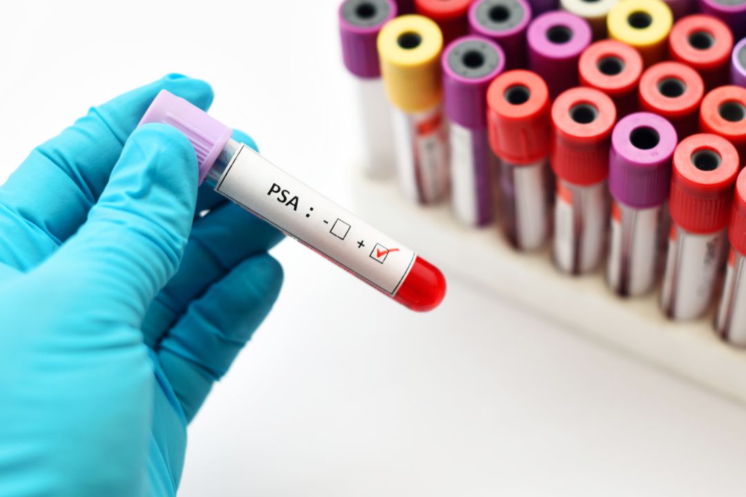 examen prostata psa alterado