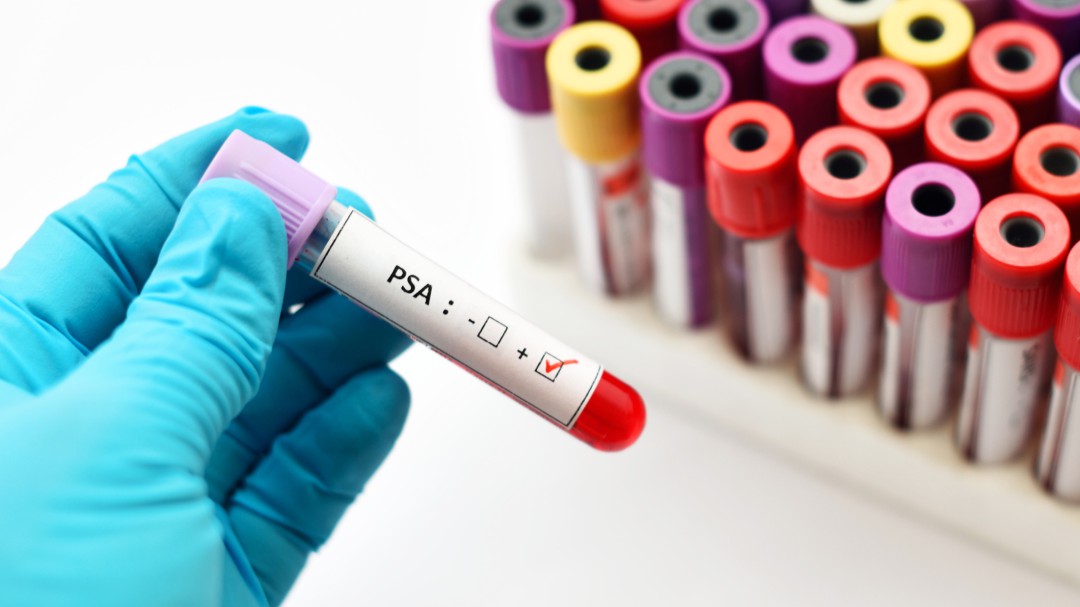 tratamientos para el cancer de prostata en mexico