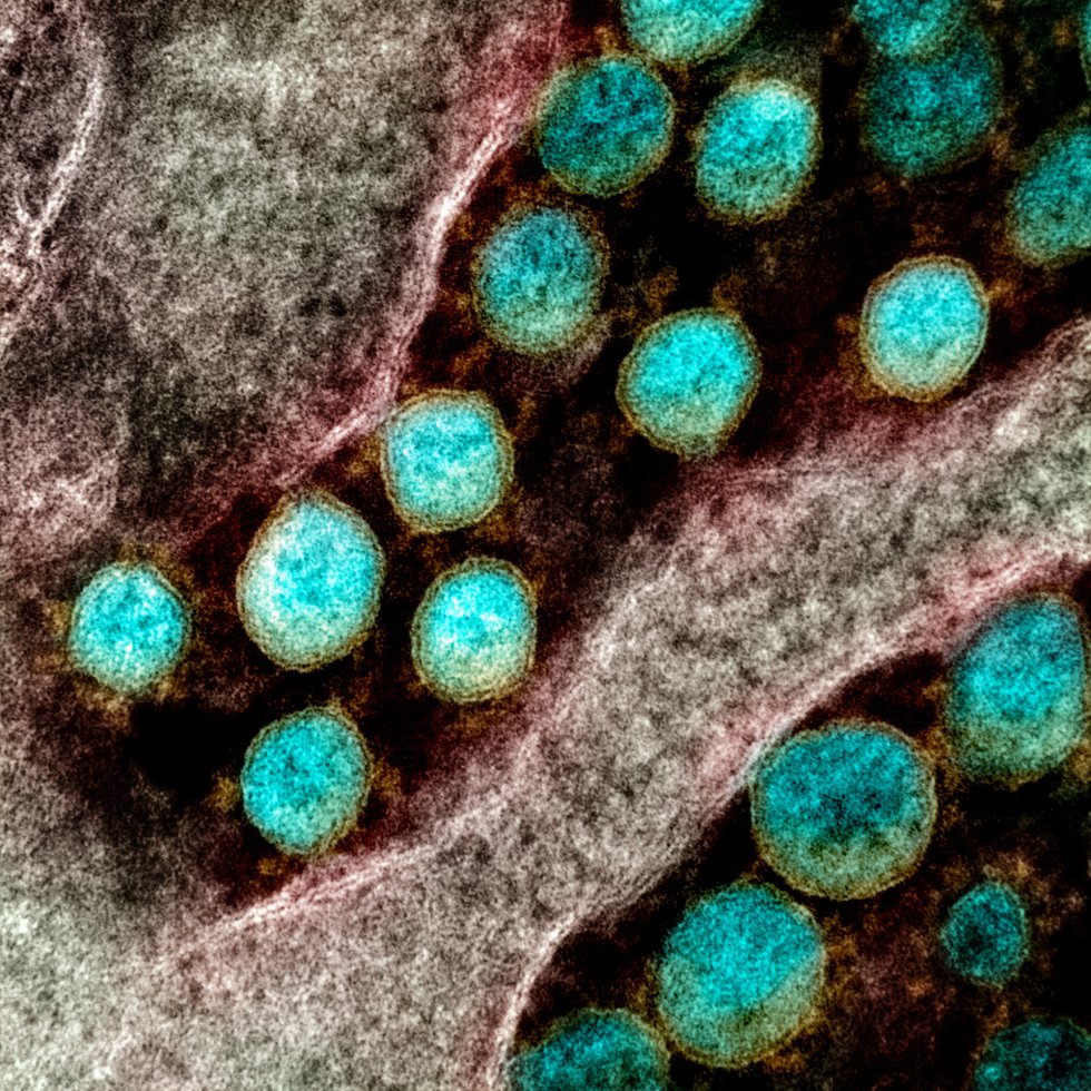 Transmisión de partículas del virus SARS-CoV-2, aislada de un paciente y con realce del color. Transmisión de partículas del virus SARS-CoV-2, aislada de un paciente y con realce del color.