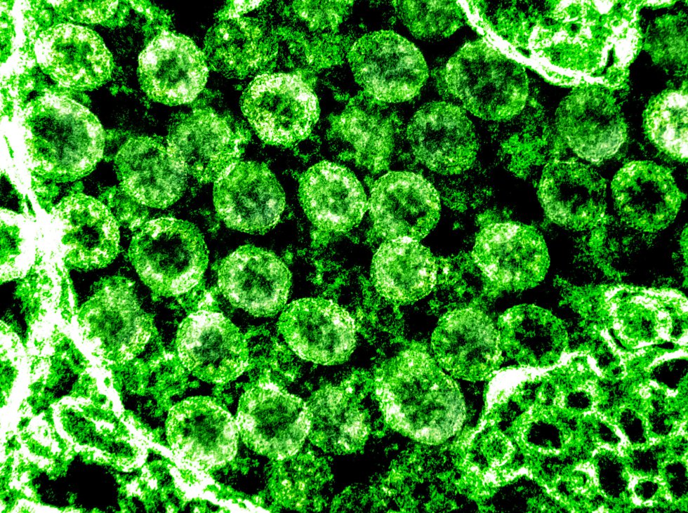 Transmisión de partículas del virus SARS-CoV-2. Transmisión de partículas del virus SARS-CoV-2.