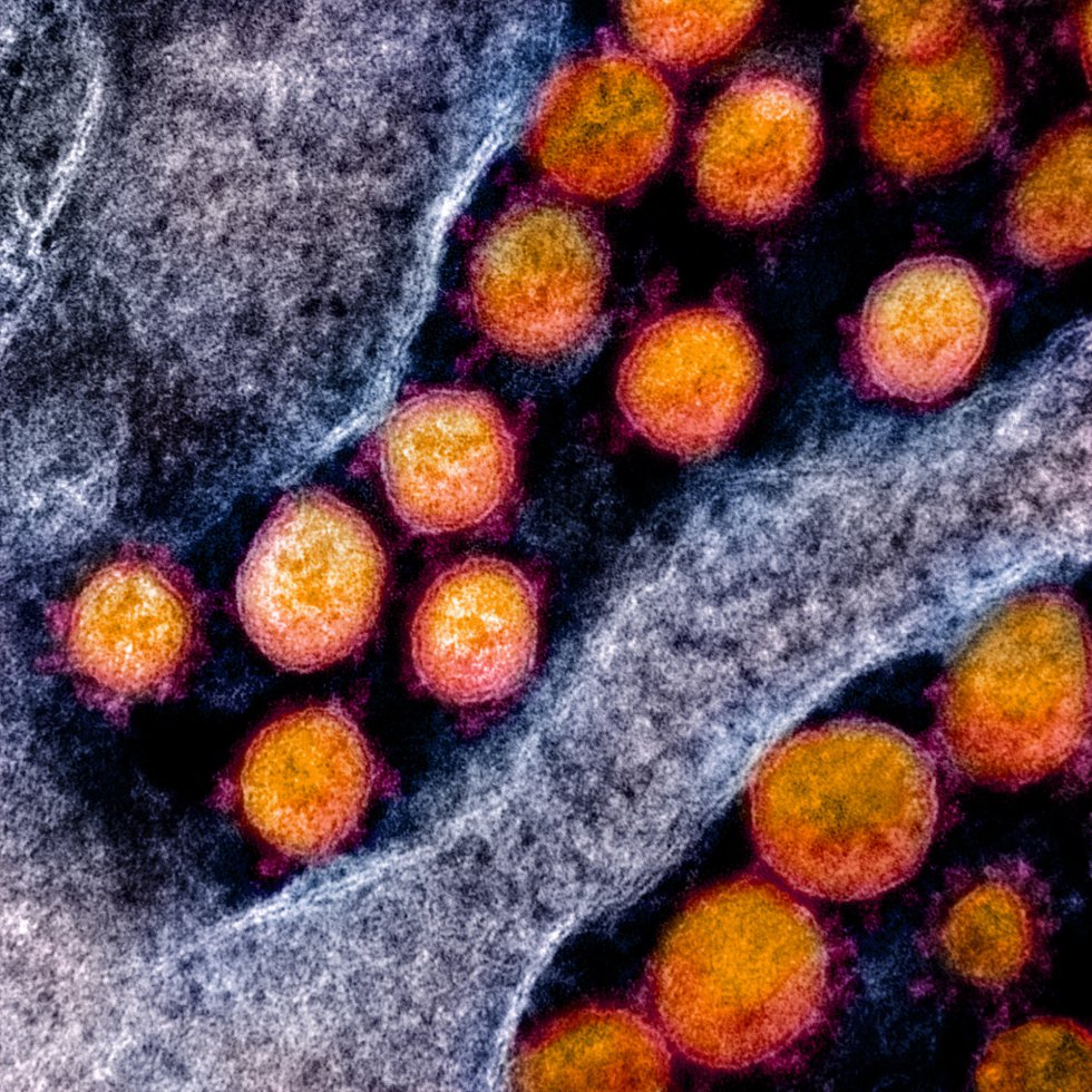 Transmisión de partículas del virus SARS-CoV-2, aislada de un paciente y con realce del color. Transmisión de partículas del virus SARS-CoV-2, aislada de un paciente y con realce del color.