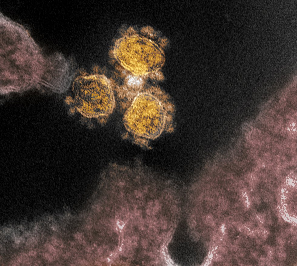 El COVID-19, con forma redonda y color amarillo, el virus que causa COVID-19, aislado de un paciente de EEUU. Mientras las partículas de virus emergen de la superficie de las células cultivadas en laboratorio y se aprecian los picos en los bordes que le dan nombre por su forma de corona. El COVID-19, con forma redonda y color amarillo, el virus que causa COVID-19, aislado de un paciente de EEUU. Mientras las partículas de virus emergen de la superficie de las células cultivadas en laboratorio y se aprecian los picos en los bordes que le dan nombre por su forma de corona.