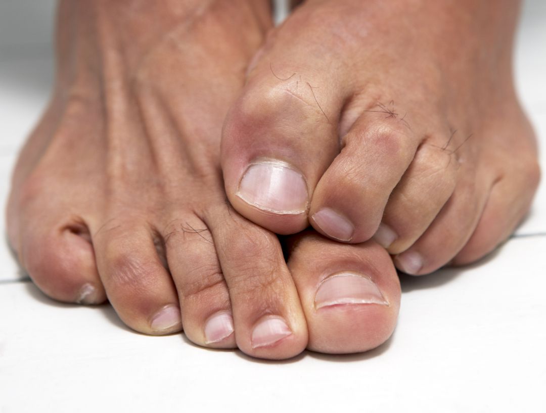 Un hombre será indemnizado por perder parte de un dedo del pie tras ser