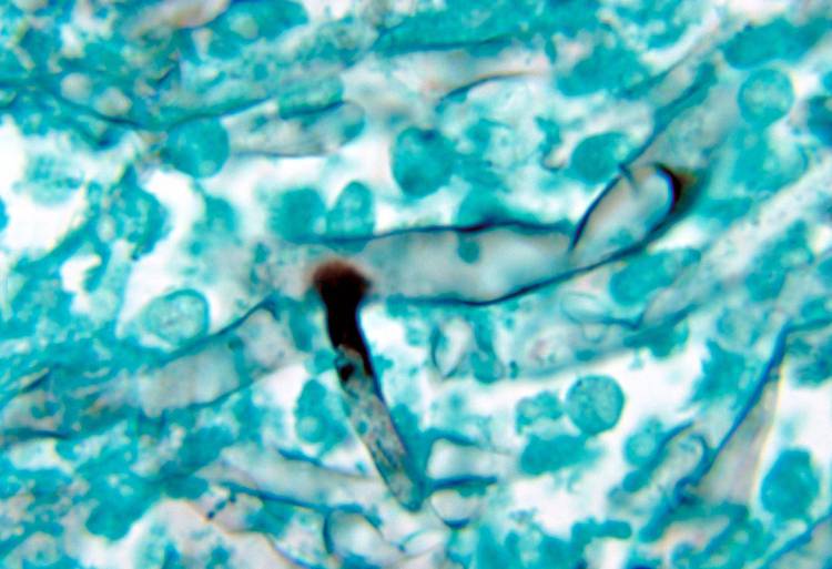 ¿Qué es la mucormicosis, la infección que está causando estragos en la